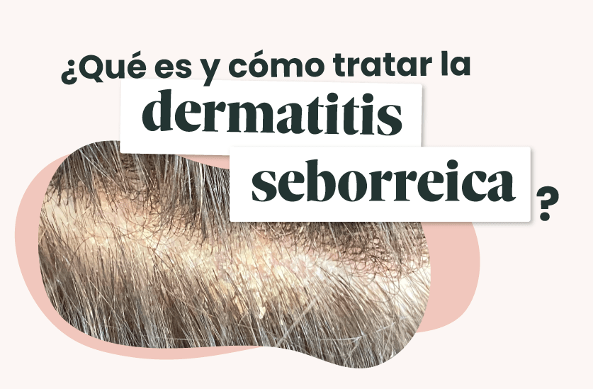 ¿Qué es y cómo tratar la dermatitis seborreica?